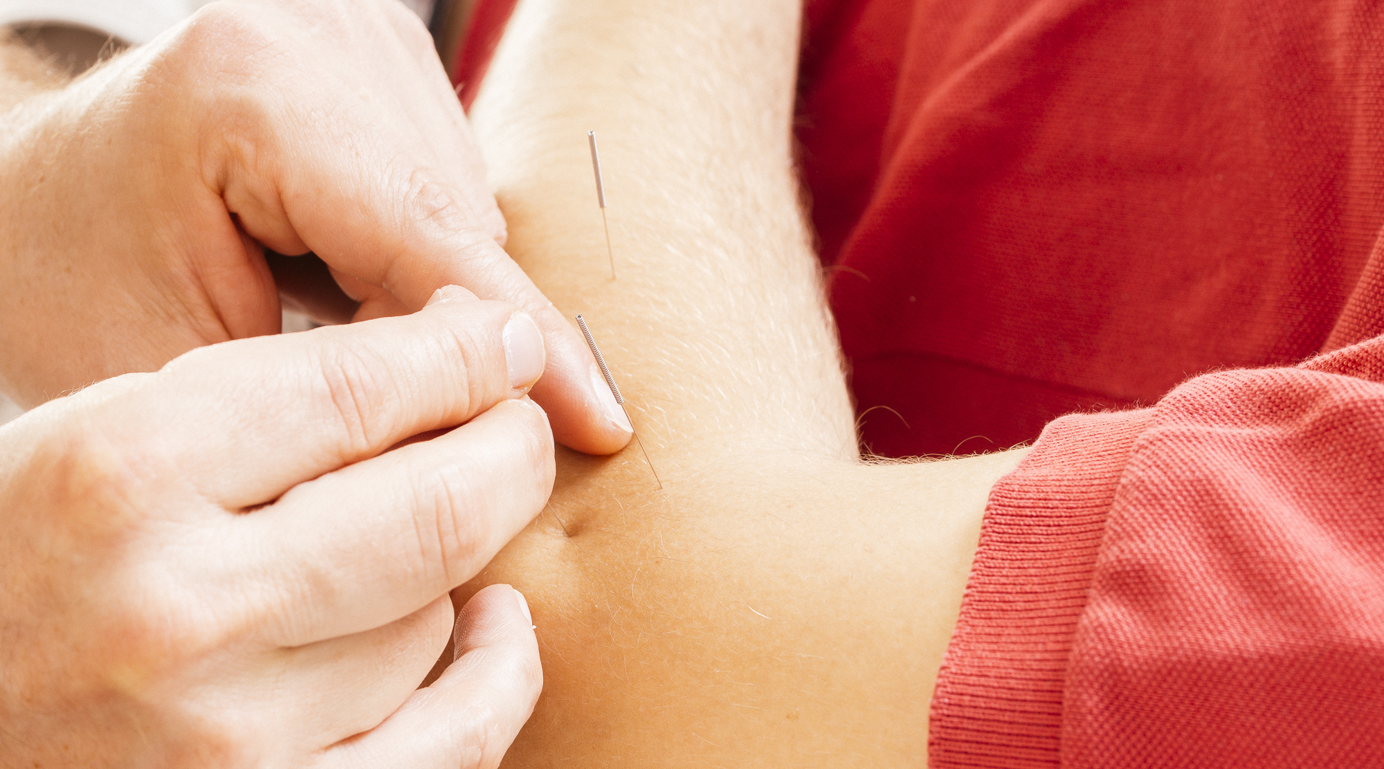 Marc Hänzi setzt Akupunkturnadeln am Ellbogen eines Patienten