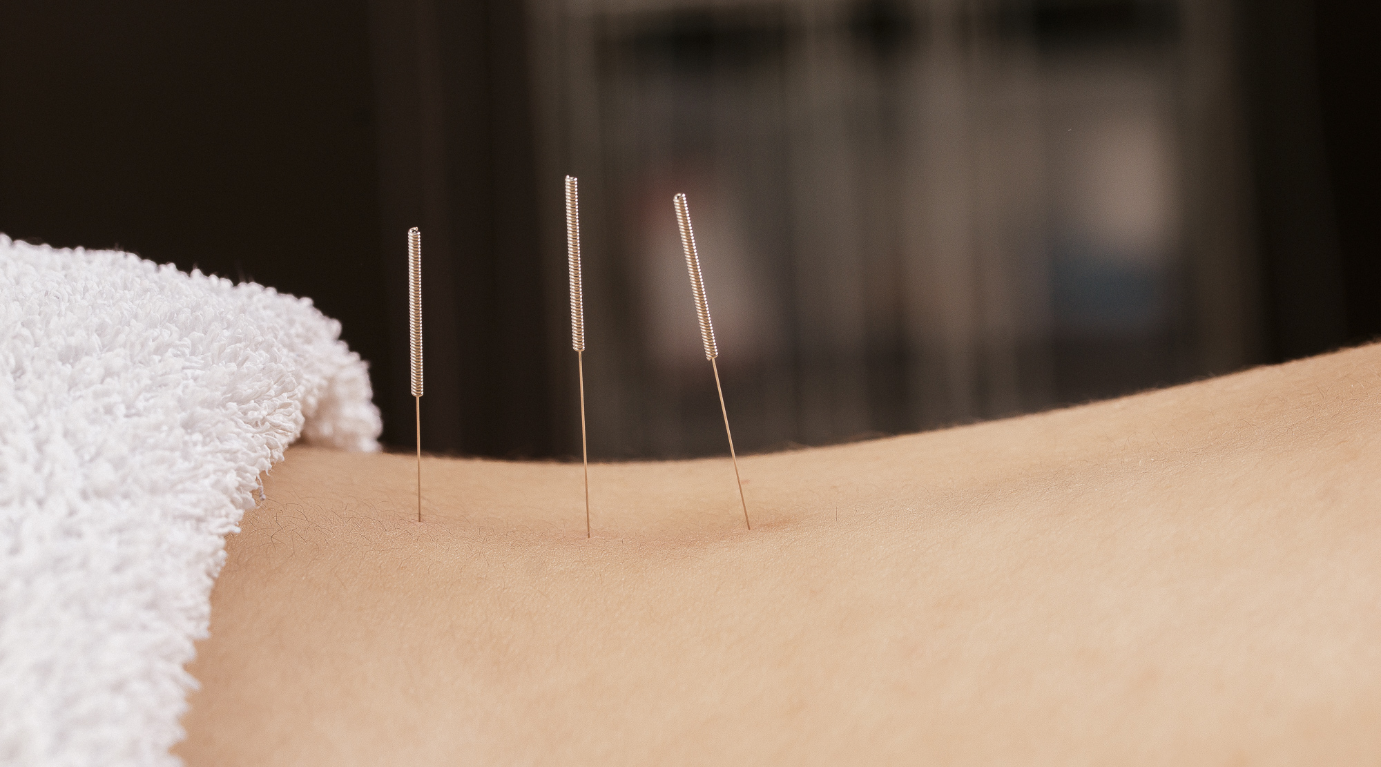 Akupunkturnadeln stimulieren Akupunkturpunkte auf dem Rücken
